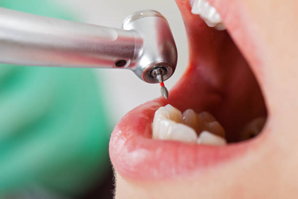 Best Emergency Treatment for Dental Infections or Abscesses in Merkel, TX